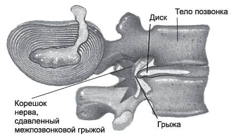Анатомия пораженного грыжей позвоночника