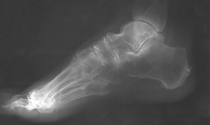 Остеопороз стопы на рентгенографии