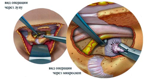 Микрохирургическое лечение секвестированной грыжи