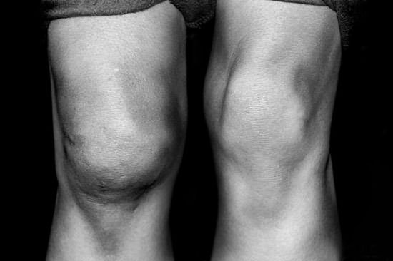 Пораженный остеопороз коленный сустав