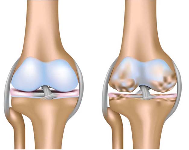 Здоровое и пораженное остеопорозом колено 