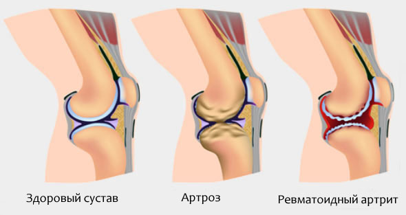 Здоровый коленный сустав и пораженный ревматоидным артритом или артрозом