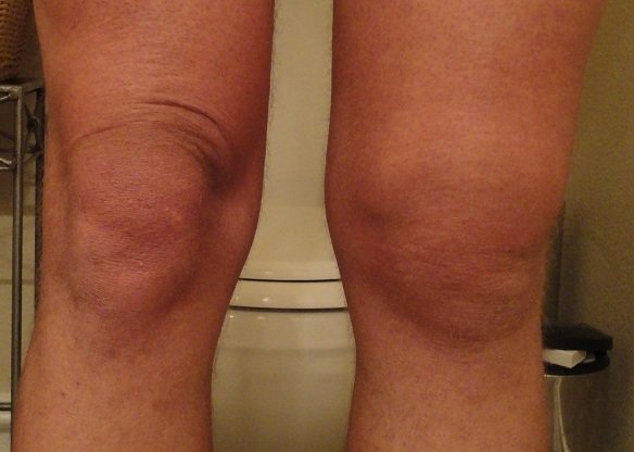 Деформация колена на начальных/средних этапах болезни Гоффа