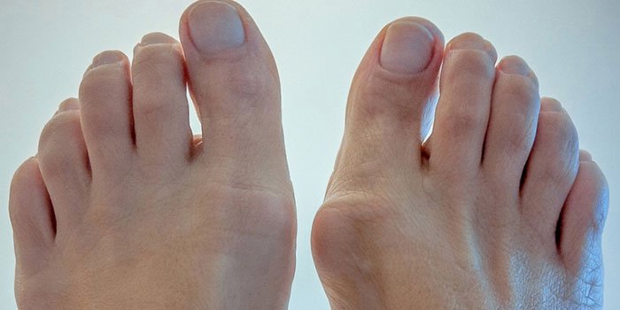 Помимо изменений в сустав стопы часто поражаются и суставы пальцев ног