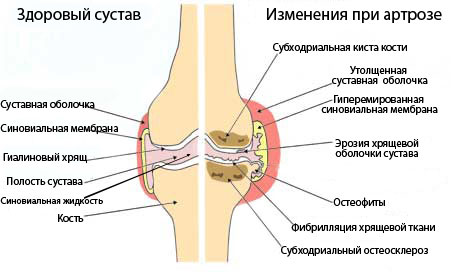 Здоровое и пораженное артрозом колено