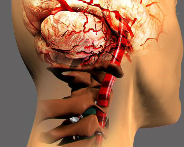 Операцию при остеохондрозе часто назначают при формировании синдрома позвоночной артерии