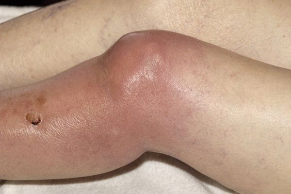 Сильное воспаление на фоне гнойного поражения коленного сустава