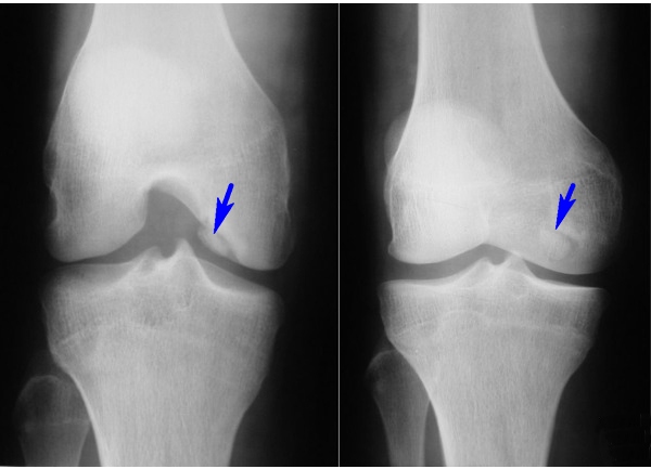 Остеопороз колена на МРТ