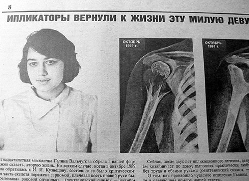 Одна из самых известных пациенток КУЗНЕЦОВА Галина ВАЛЬЧУГОВА излечилась от запущенной формы остеосаркомы