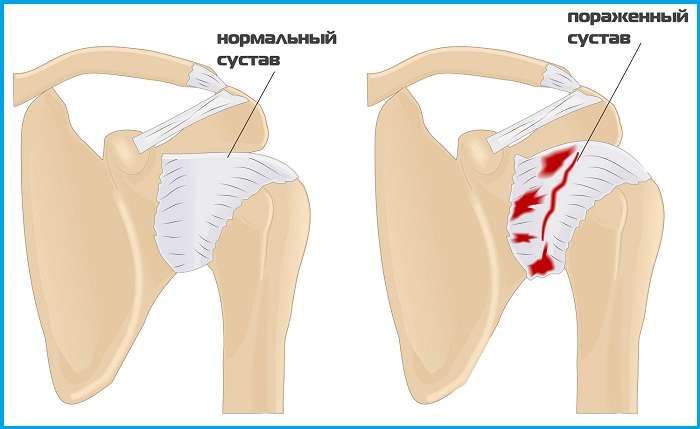 Плечелопаточный периартрит