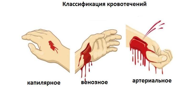 виды кровотечений