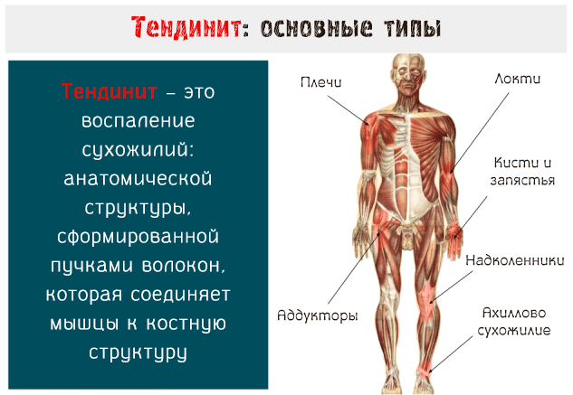 Иллюстрация возможных участков поражения сухожилий тенденитом