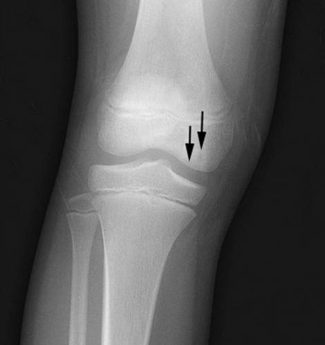 Некроз коленного сустава – рентген изображение