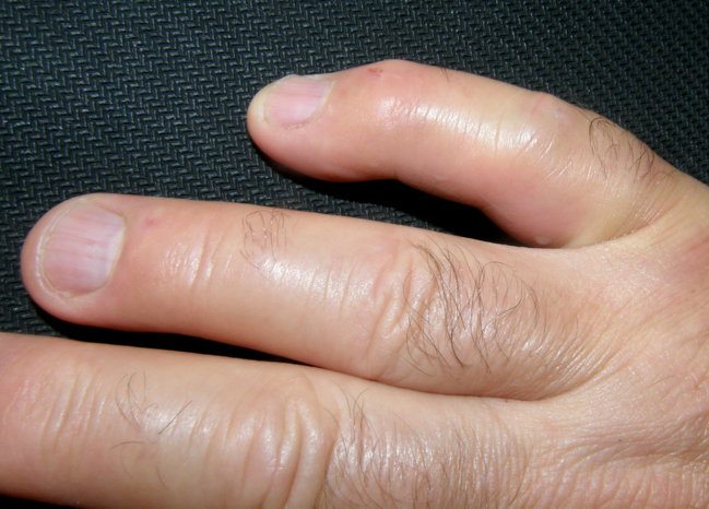 Опухшие пальцы руки человека