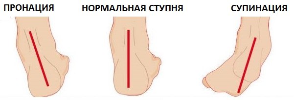 Закрытый двухлодыжечный перелом левой голени со смещением