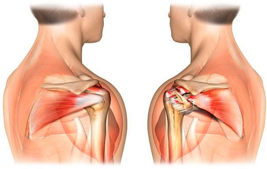Повреждение мышцы плеча