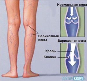 Болезнь сосудов ног симптомы и их лечение