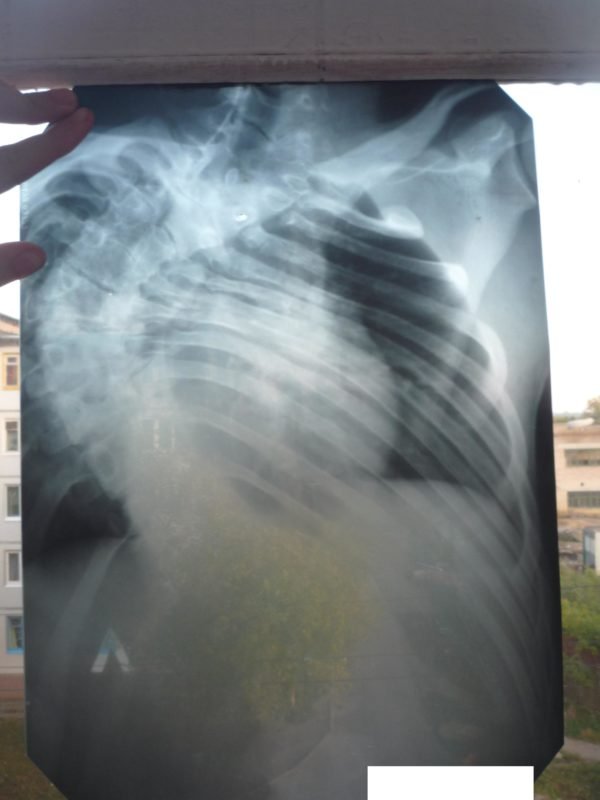Рентгеновские снимки всего позвоночника предоставляют возможность провести качественную диагностику сколиоза