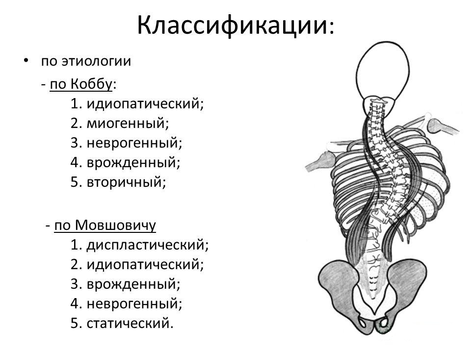 Классификации сколиоза