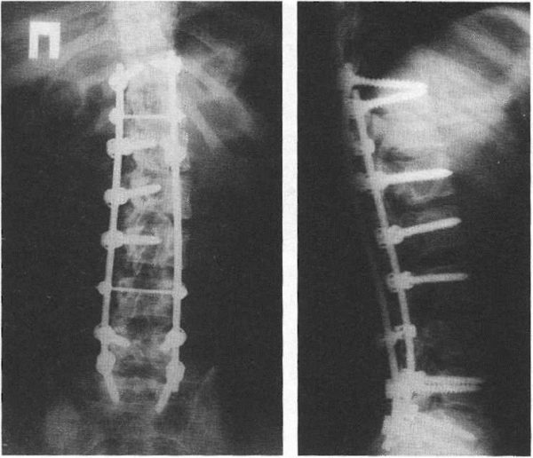 Оперативное лечение сколиоза с применением конструкции Cotrel—Dubousset