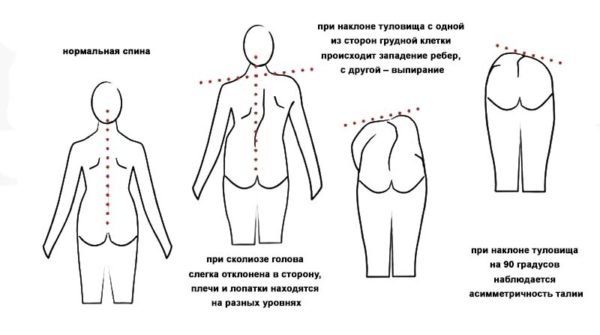 Признаки сколиоза