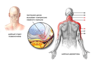 Радикулит