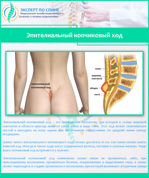 Эпителиальный копчиковый ход