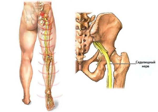 Локализация седалищного нерва