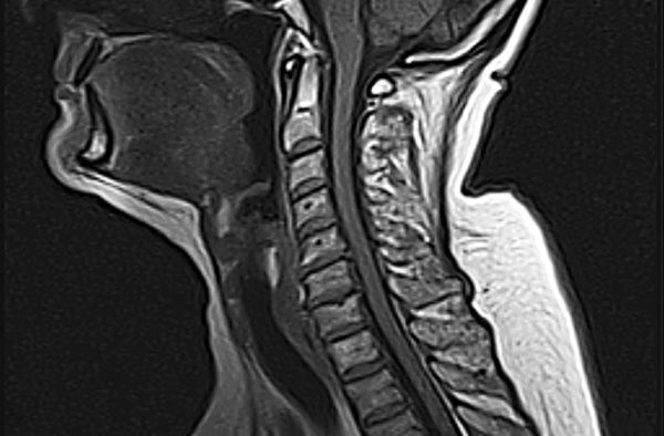 МРТ шейного отдела