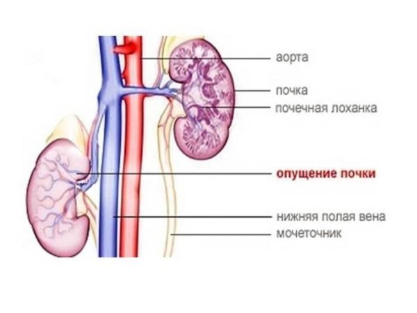 Нефроптоз - опущение почки