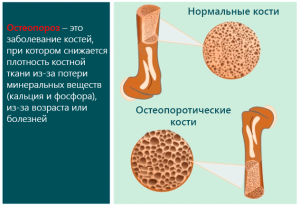 Остеопороз – это заболевание костей, при котором снижается плотность костной ткани