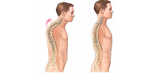 Патологический кифоз шейного отдела позвоночника