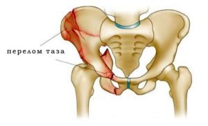 Травматические повреждения участков малого таза или расположенных рядом мышц.