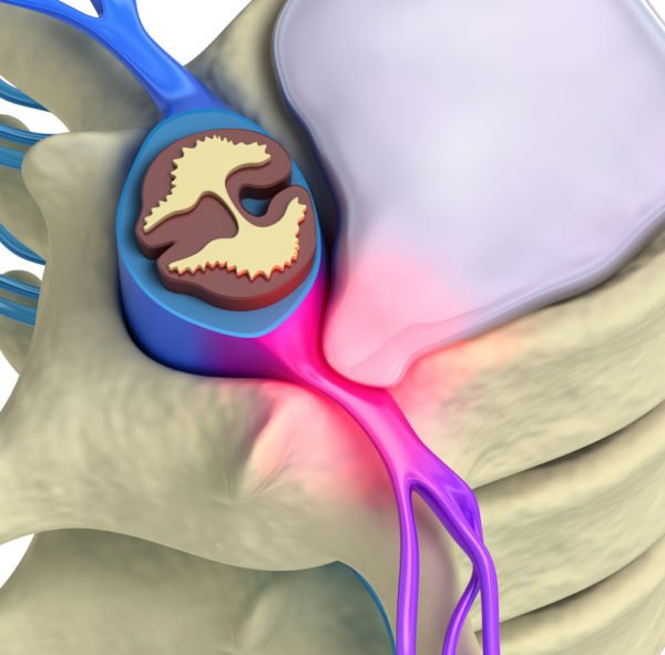 Радикулопатия возникает при ущемлении корешка спинного мозга
