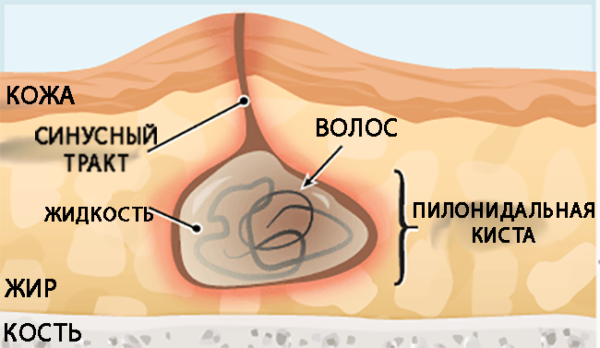 Схема кисты копчика