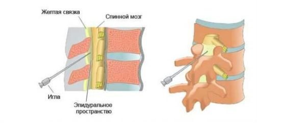 Выполнение эпидуральной блокады требует высокой профессиональности