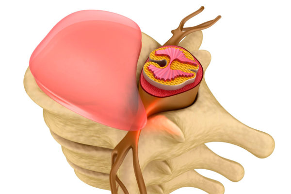 Межпозвонковая грыжа