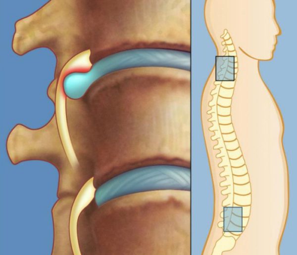 Разрушение межпозвоночного диска приводит к образованию грыжи, что проявляется болью в спине