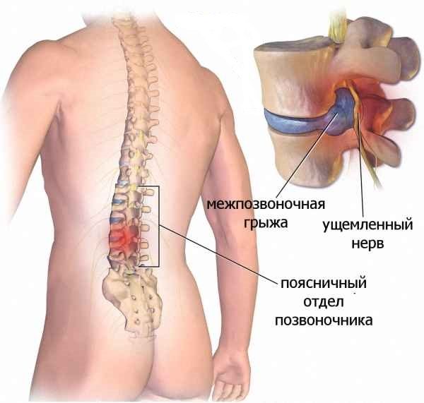 Грыжа поясничного отдела