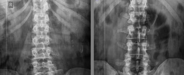 На рентгеновских снимках дужки позвонков отчетливо просматриваются, и если они симметричны, это указывает на отсутствие торсии