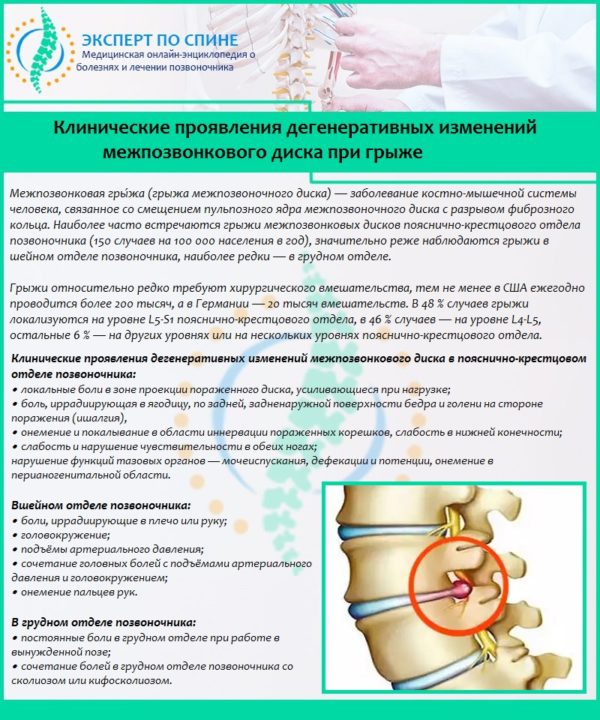 Клинические проявления дегенеративных изменений межпозвонкового диска при грыже