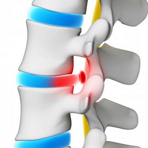 Межпозвонковая грыжа