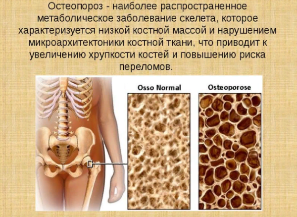 Остеопороз - особенности заболевания