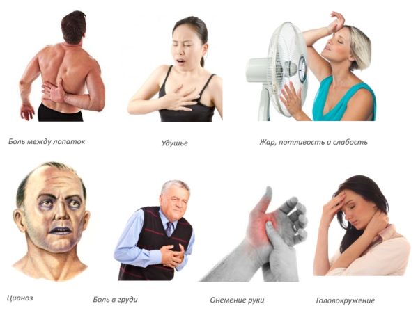 Симптомы аритмии при остеохондрозе