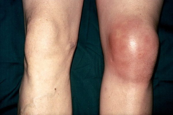 Внешние признаки инфекционного поражения коленного сустава