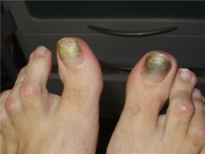 На фото заболевание ногтей, вызванное синегнойной палочкой (онихия псевдомоназная)