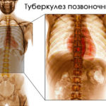 Туберкулез костей и суставов
