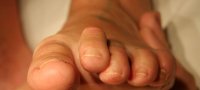 Основные симптомы и способы лечения вывиха пальца на ноге