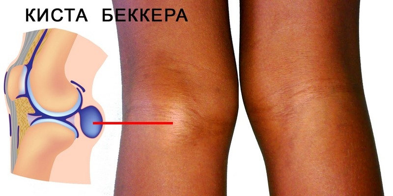 Мениск колена: что это такое, причины повреждений и методы лечения