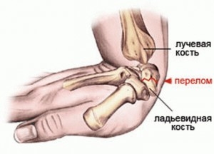 Перелом плюсневой кости стопы: признаки и лечение